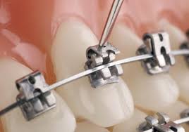 Niềng răng mắc cài tự buộc là gì?